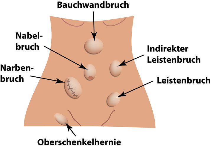 Lücken in der Bauchwand